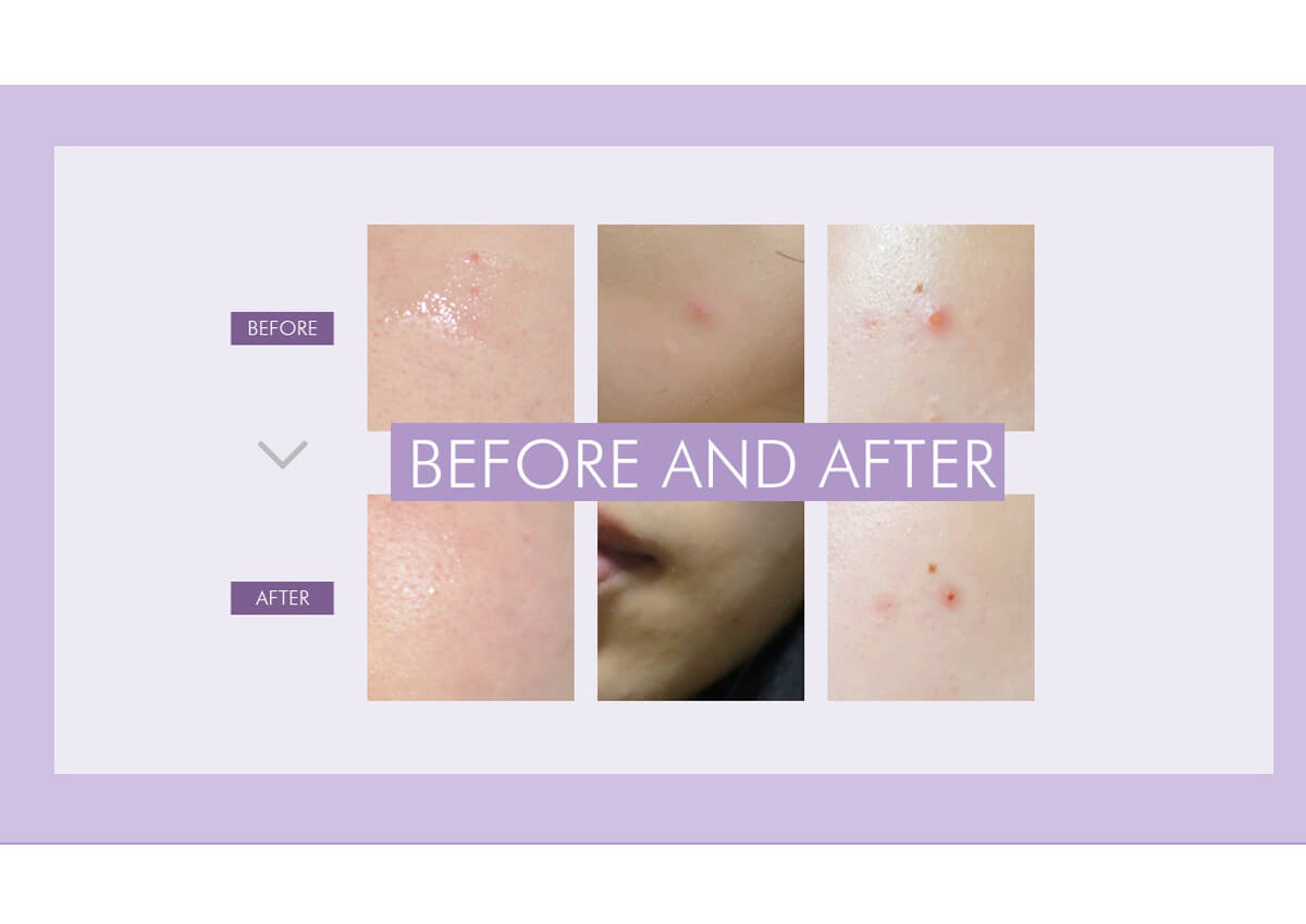 The result of using a concentrated remedy for problem skin Acleon from the Korean manufacturer Anacis